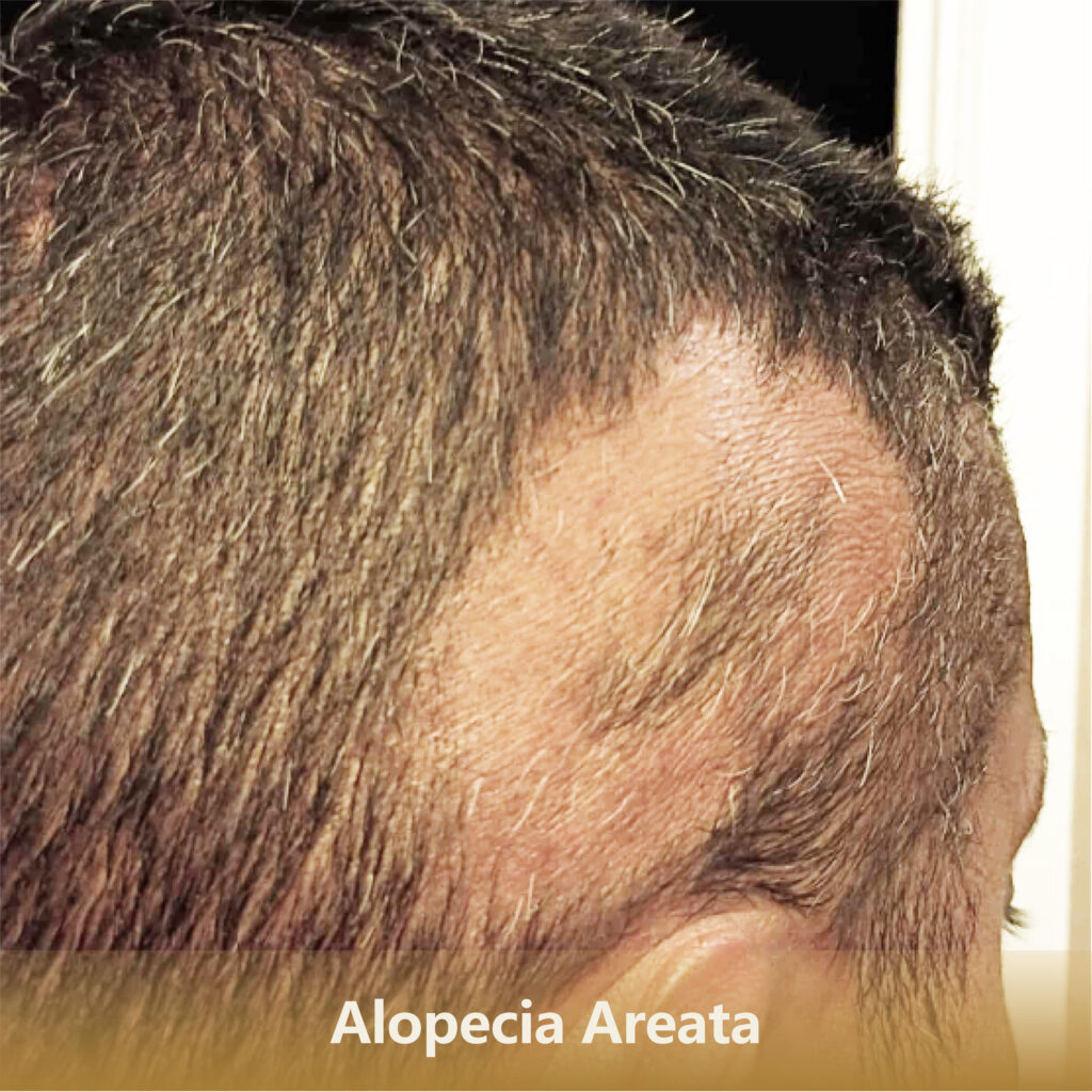 2 斑秃Alopecia Areata 1 1024x1024