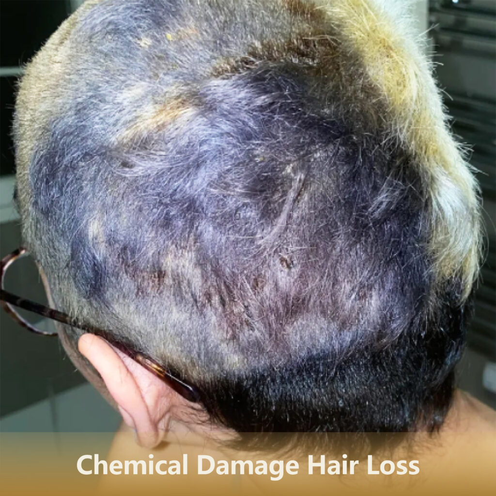 6 化学脱发Chemical Damage Hair Loss 1 1024x1024