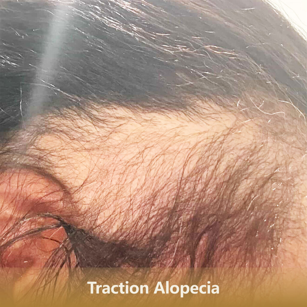 7 牵引性Traction Alopecia 1 1024x1024