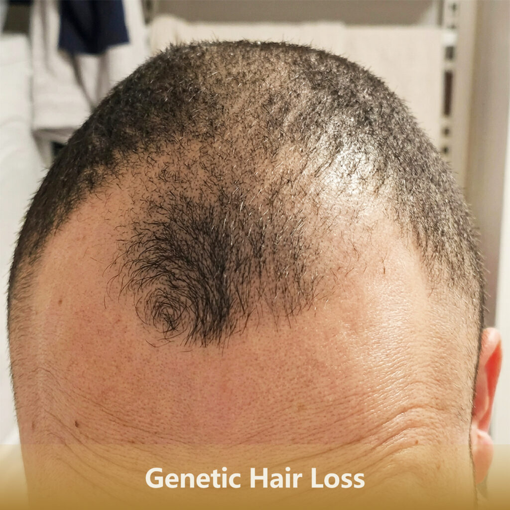 9 遗传Genetic Hair Loss 1 1024x1024